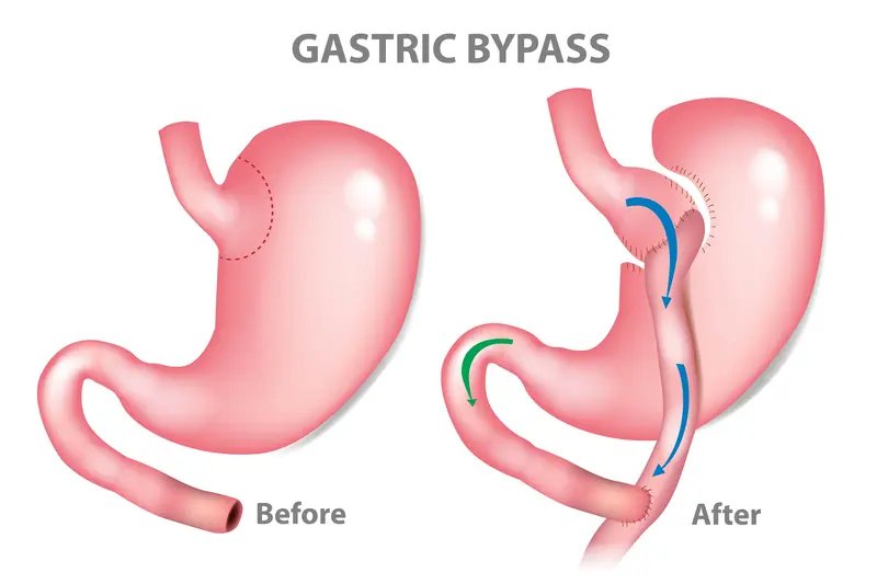 Gastric-Bypass-Surgery